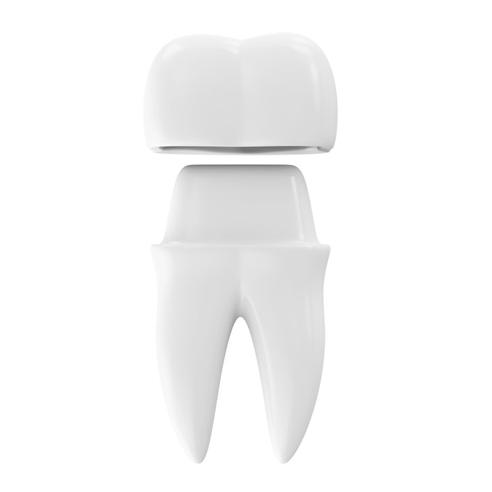 Implant Crowns