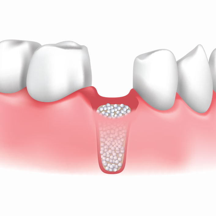 Bone Grafting