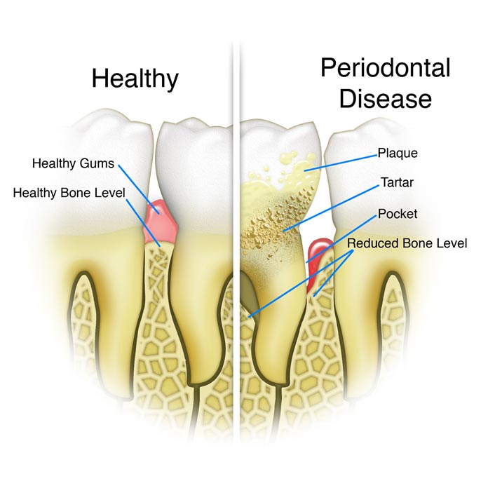 Periodontal/Gum Disease