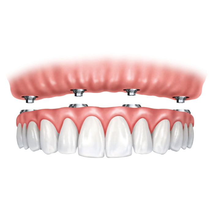Implant-supported dentures
