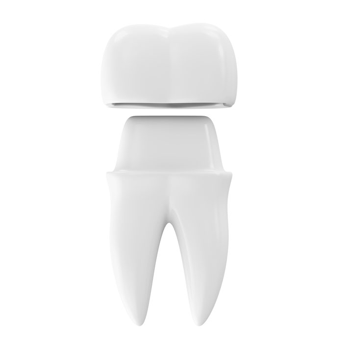 Implant Crowns